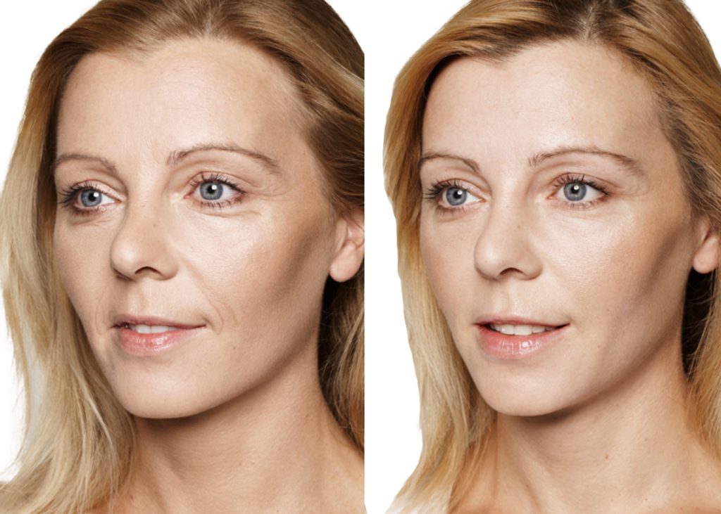 nasolabial folds treatment