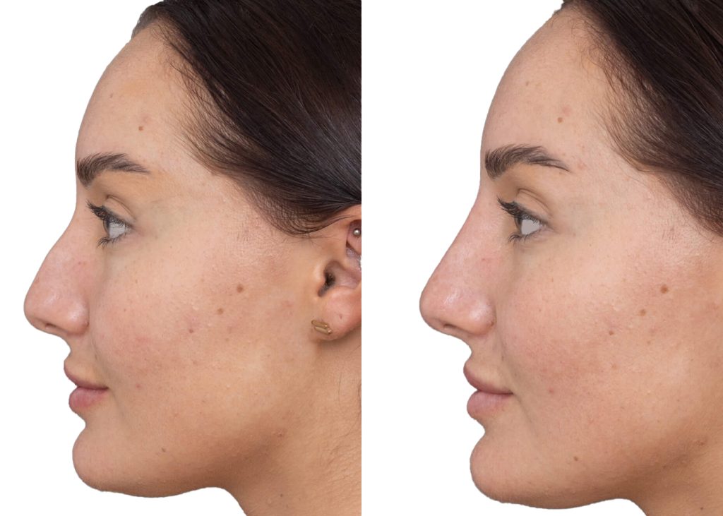 nose filler