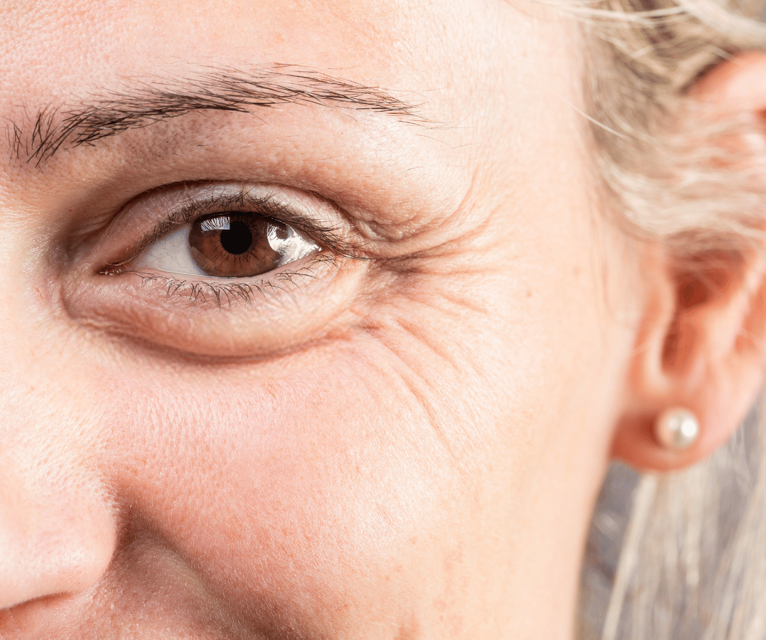 Crows feet Treatment