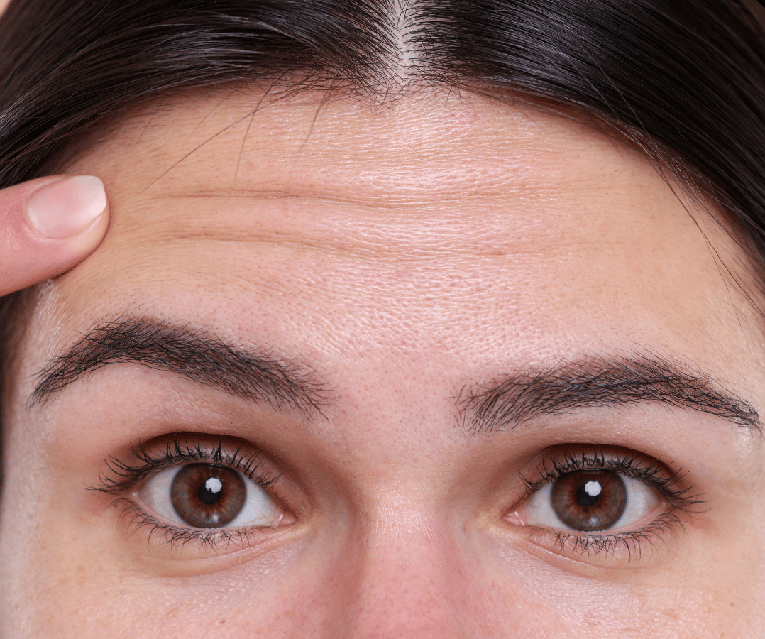 Forehead Wrinkle Treatment