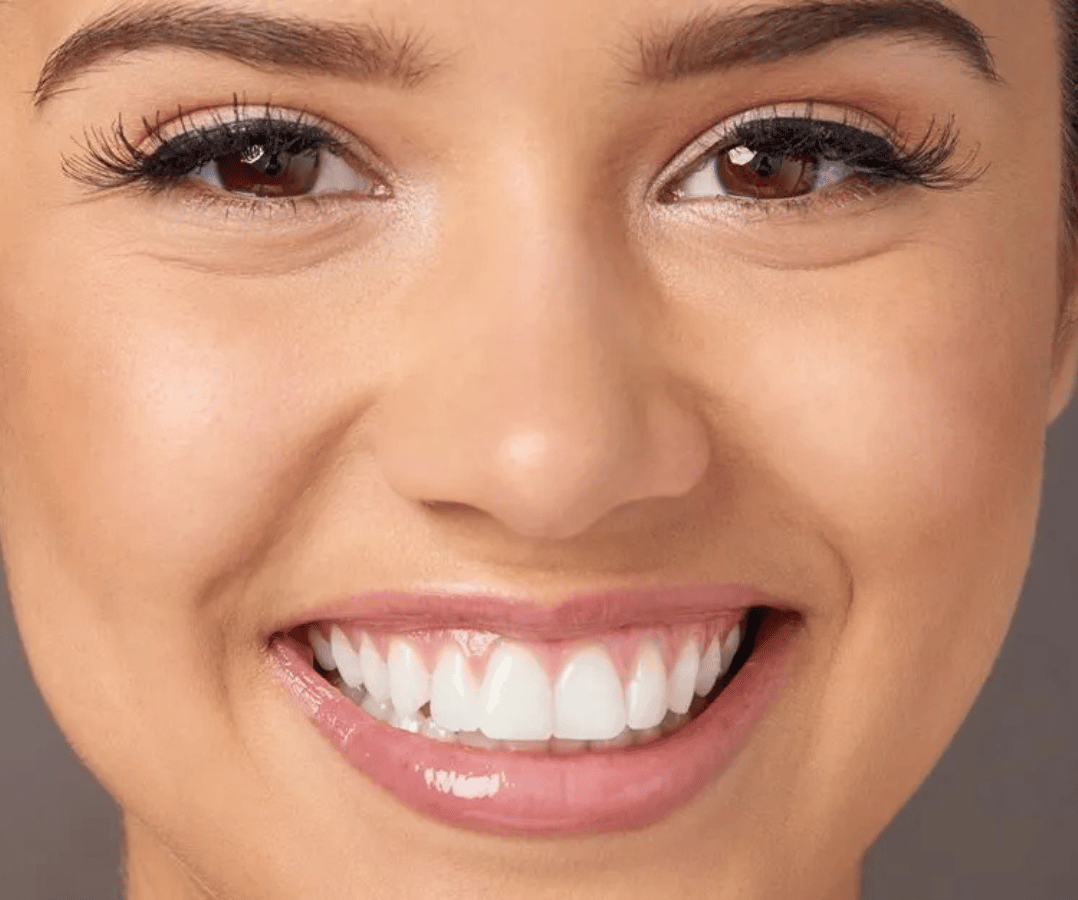 Gummy Smile Treatment