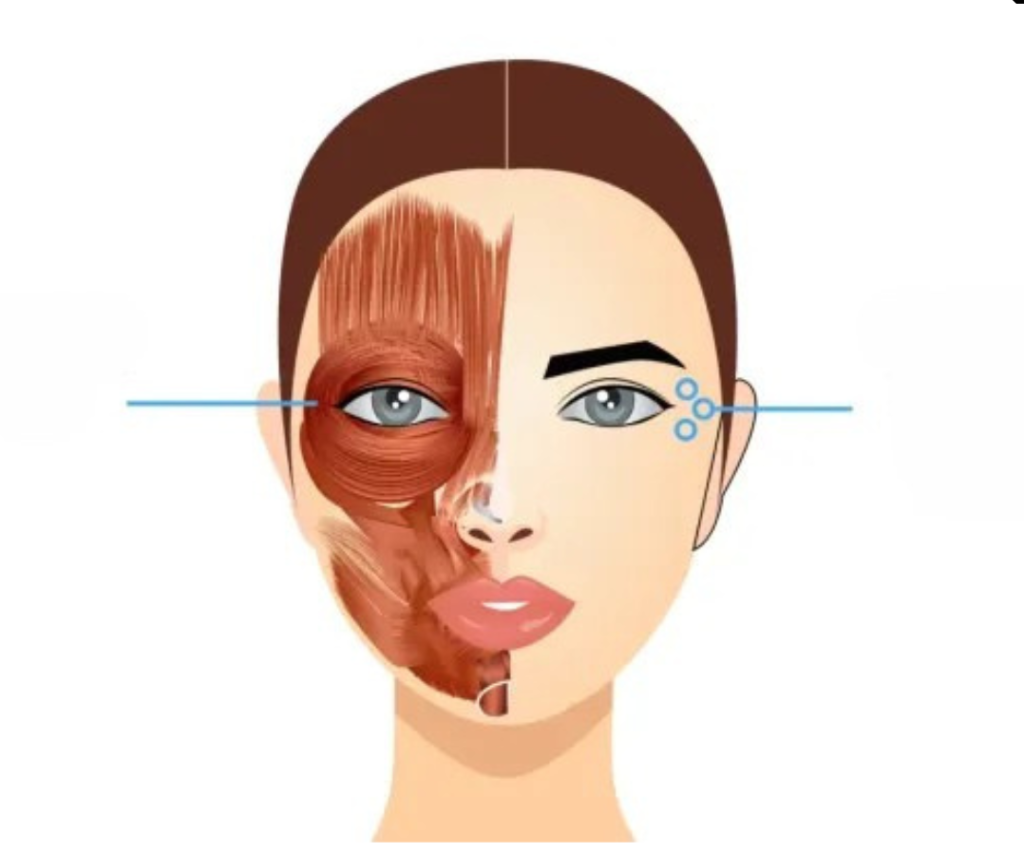 injection points crows feet