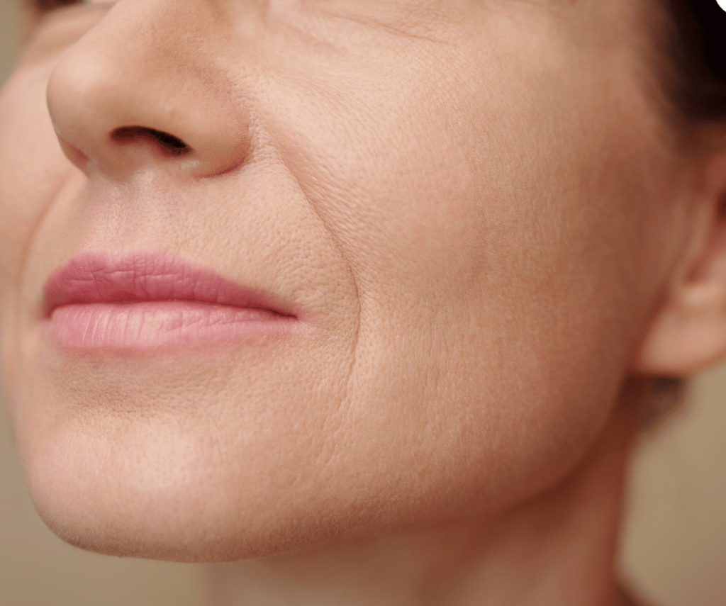 Nasolabial Treatment