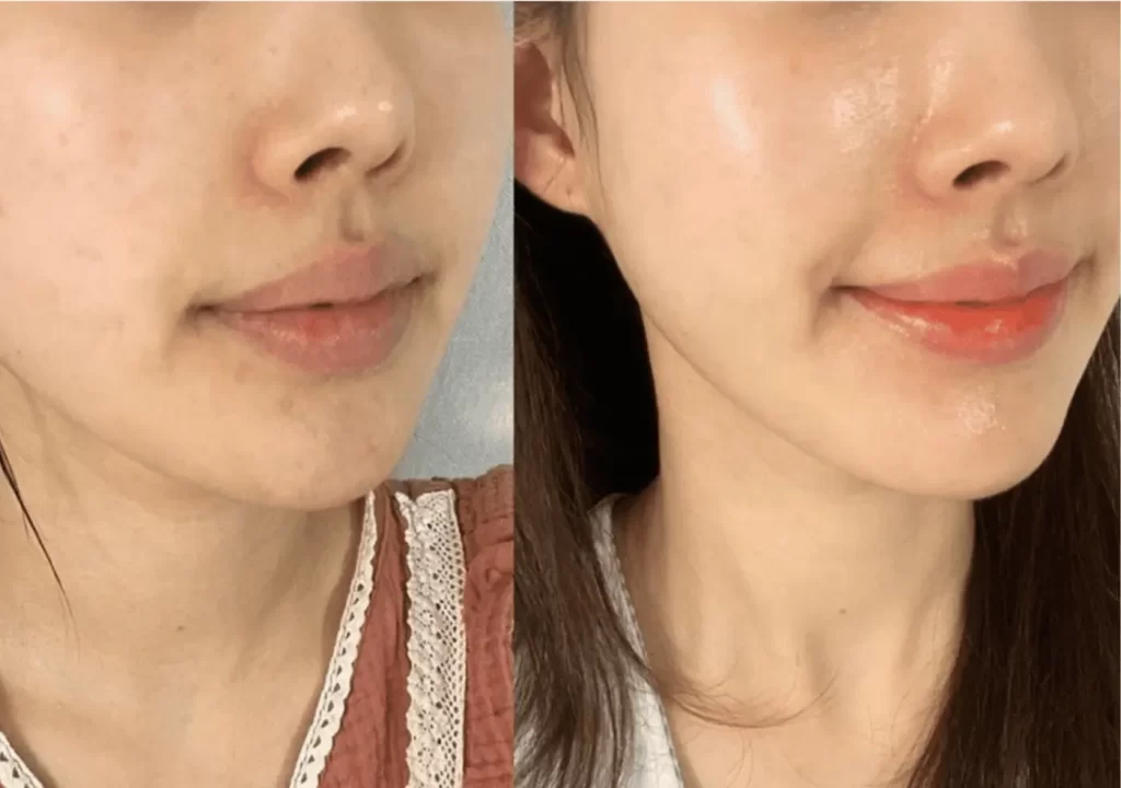 Before and after exosome treatment