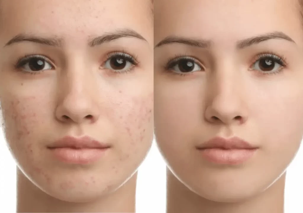 Before and after exosome treatment