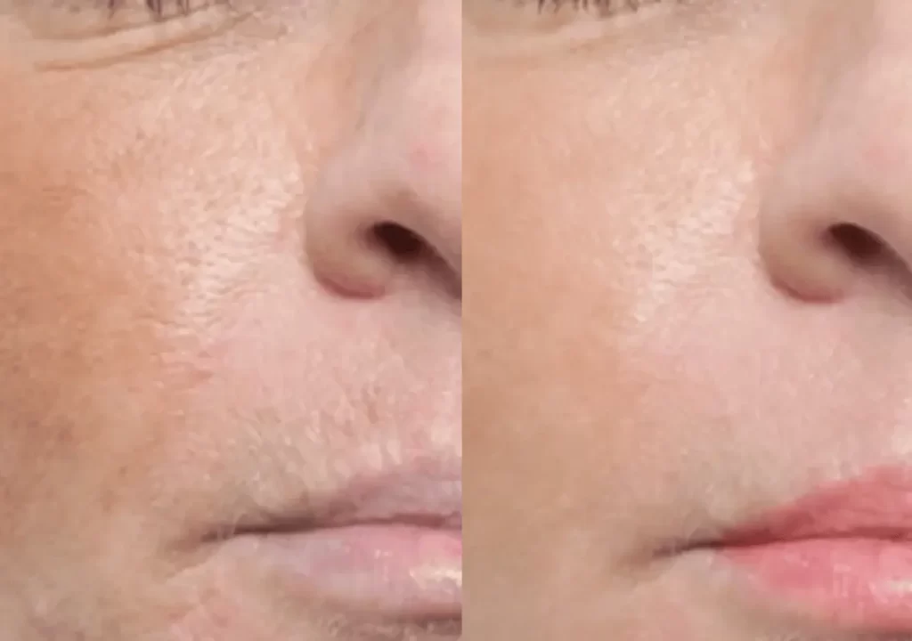 Before and after exosome treatment