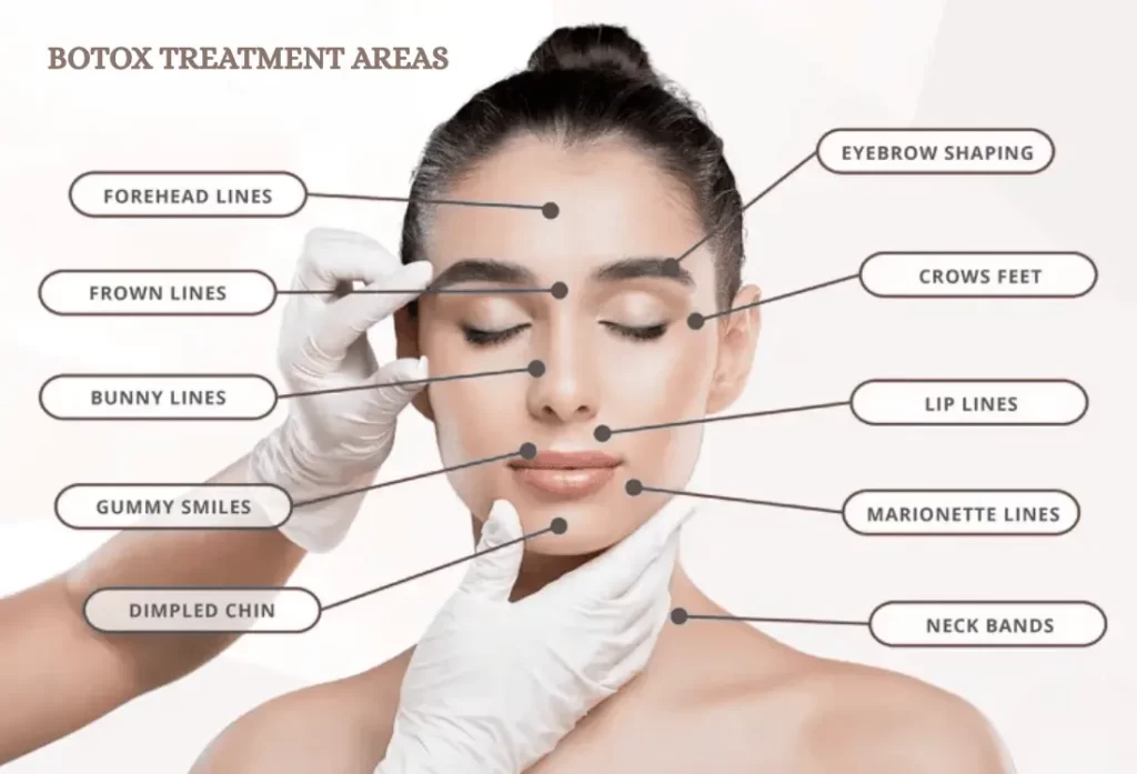 Botox treatment areas