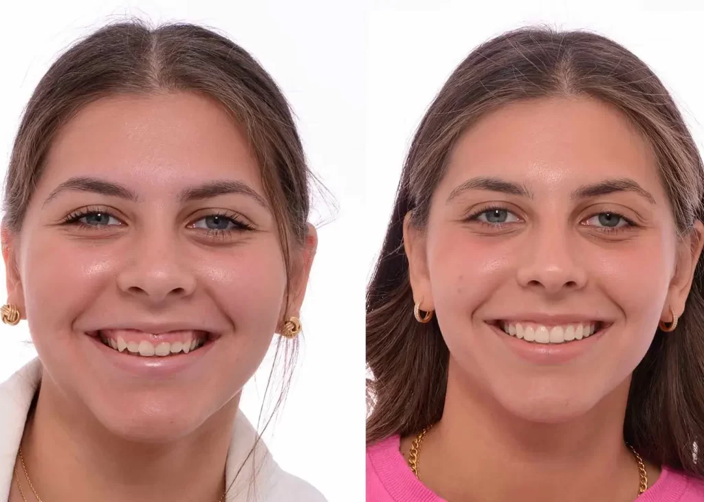 gummy smile treatment