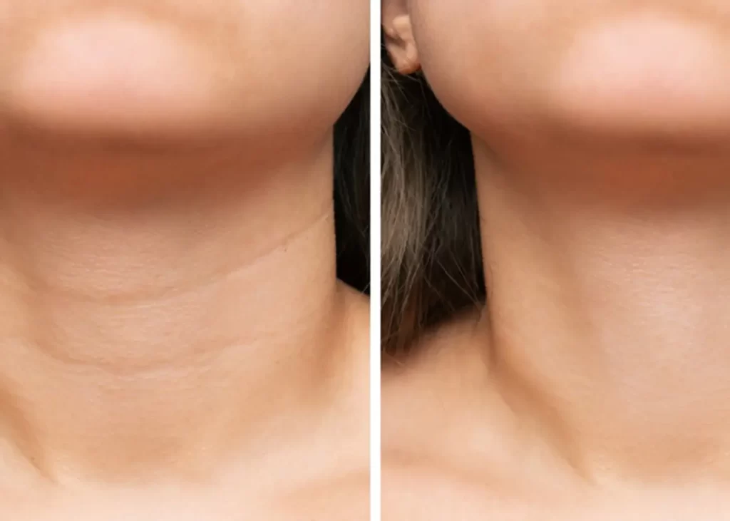 Neck Bands Treatment