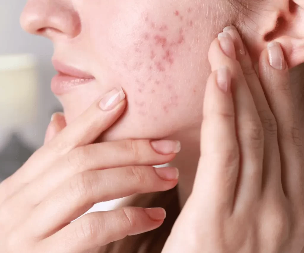 acne scar exosome treatment