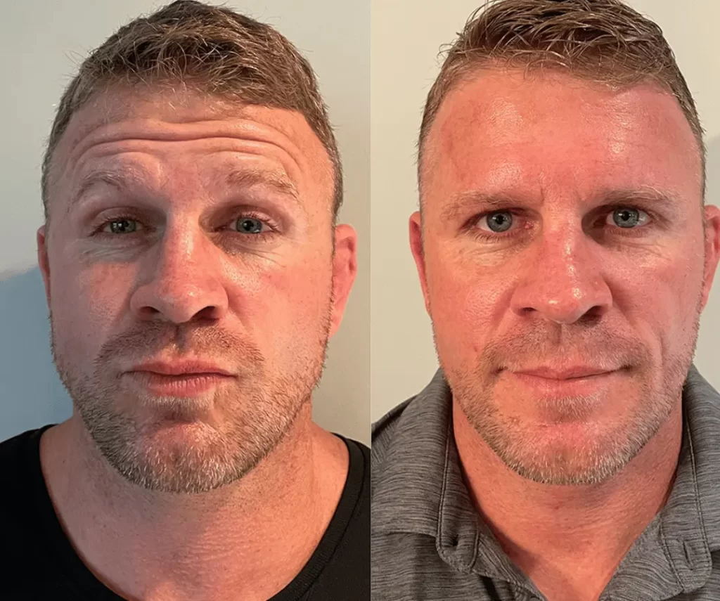 before and after mens aesthetic treatments