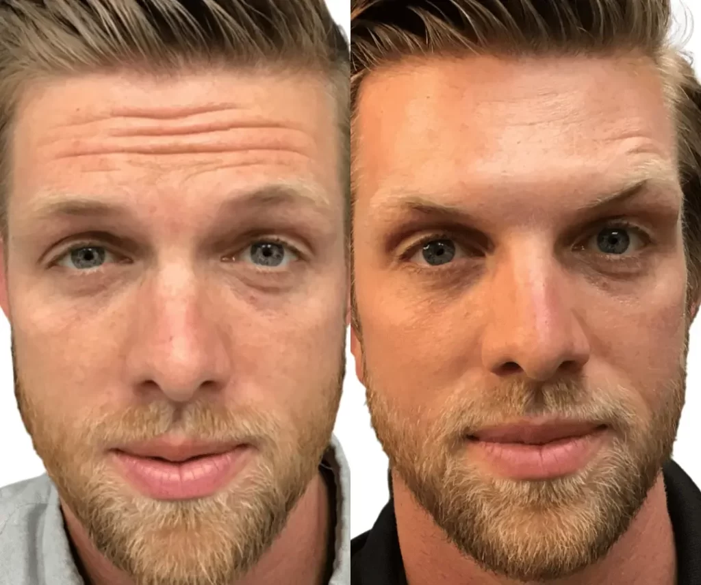 before and after mens aesthetic treatments