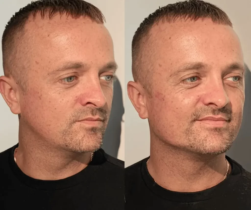 before and after mens aesthetic treatments