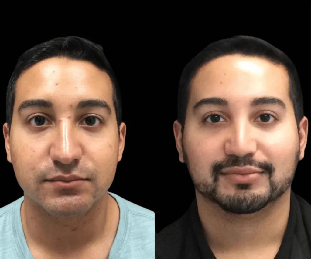 before and after mens aesthetic treatments