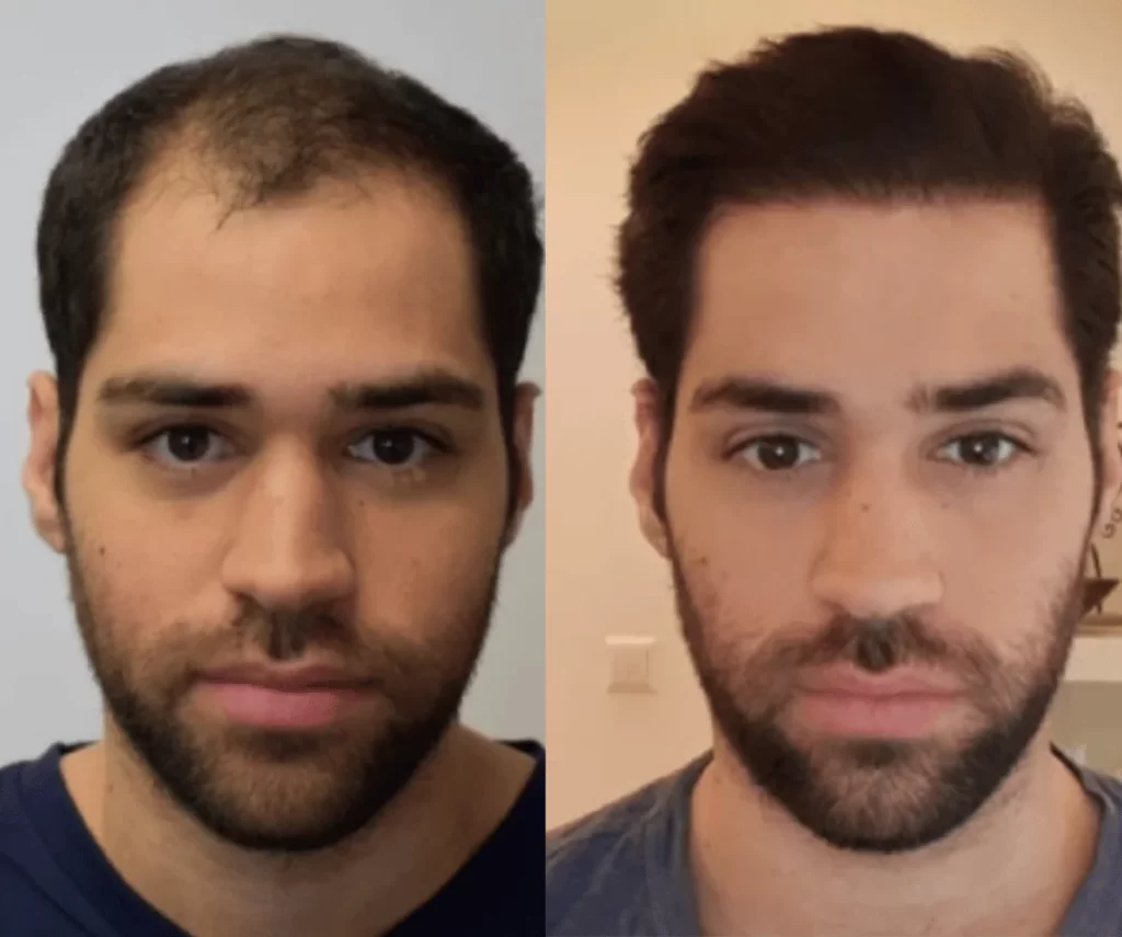 before and after mens aesthetic treatments
