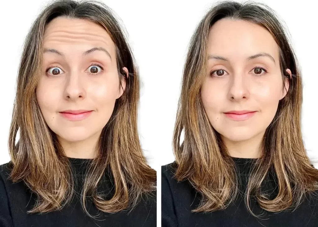 Forehead lines Wrinkles