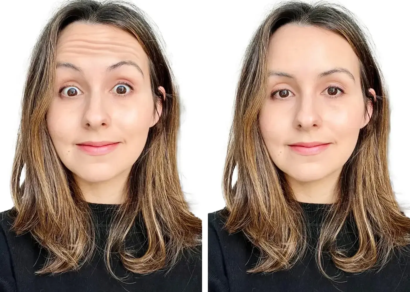 Forehead lines Wrinkles