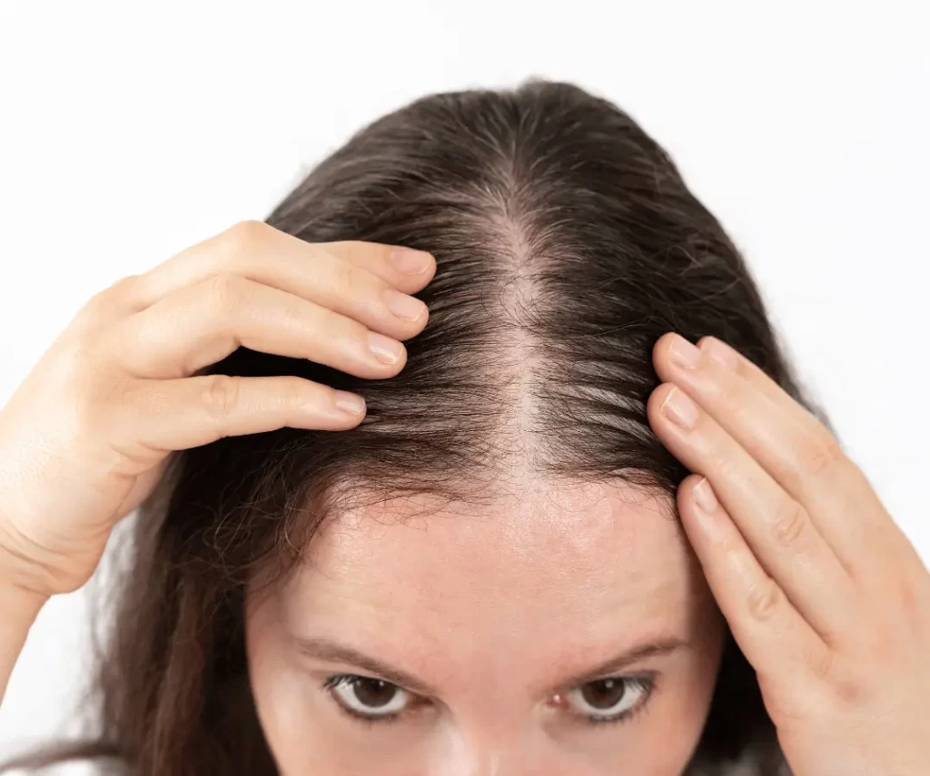 Hair Restoration exosome treatment