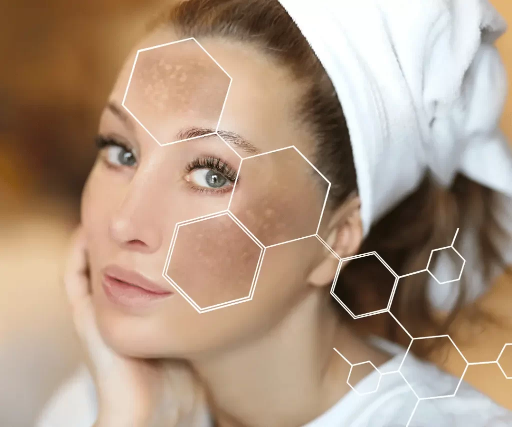 hyperpigmentation exosome treatment